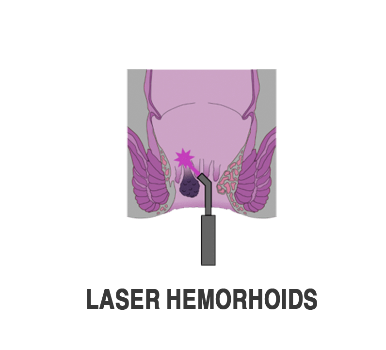 جراحات-الشرج-بالليزر