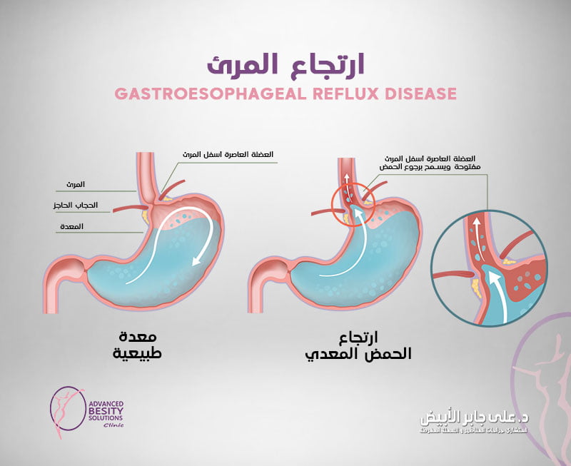 ما هو ارتجاع المرئ