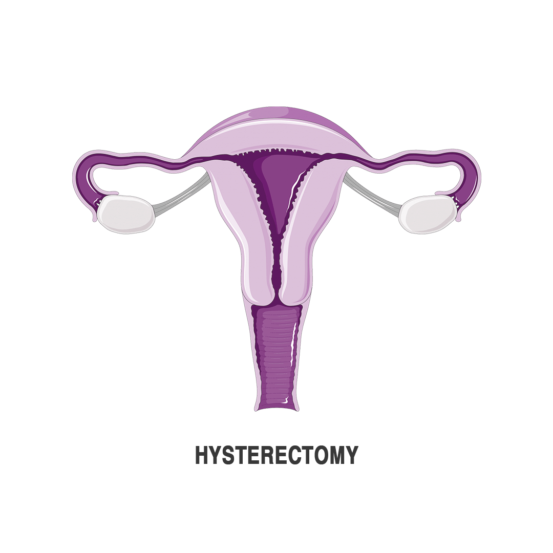 استئصال الرحم بالمنظار