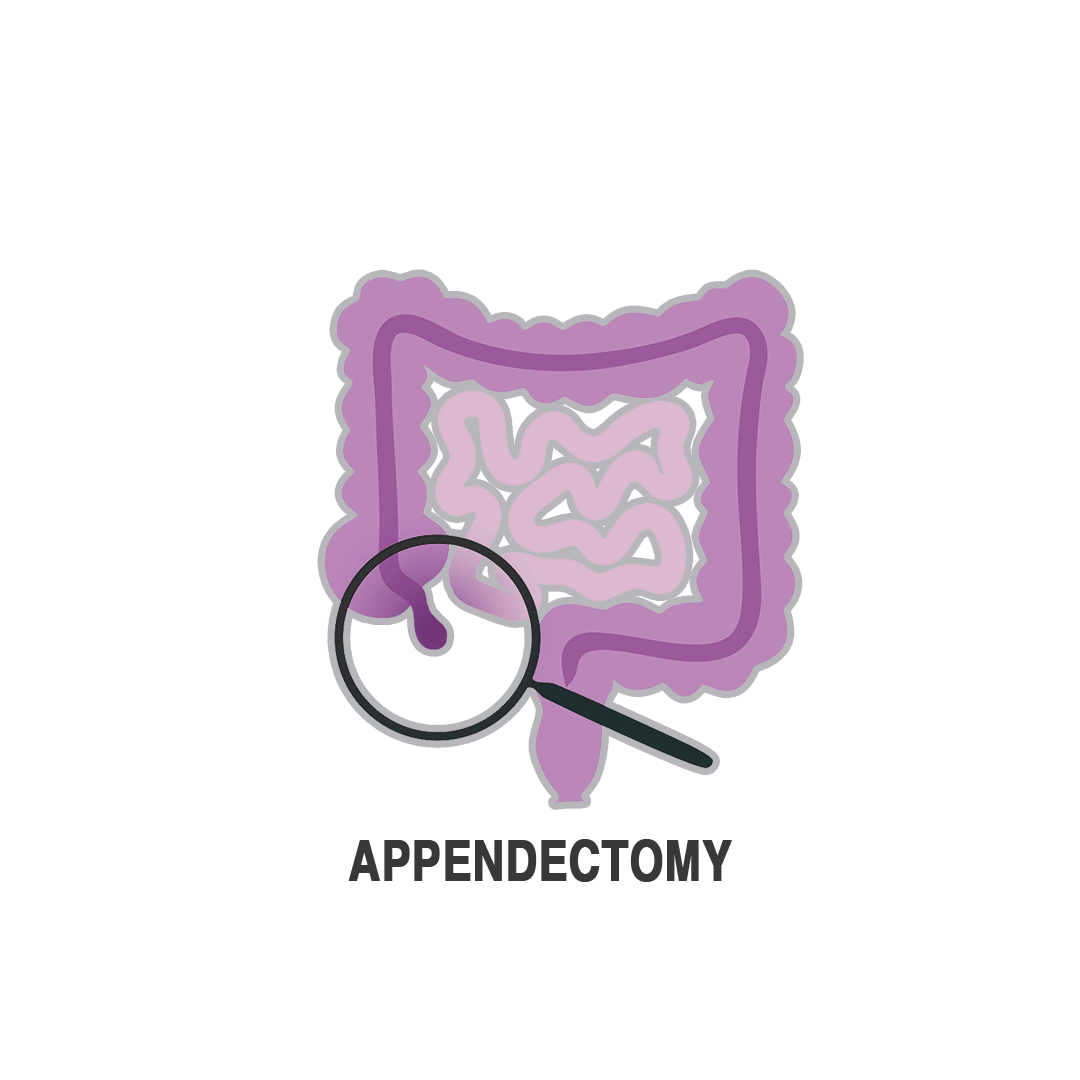 استئصال الزائدة الدودية بالمنظار