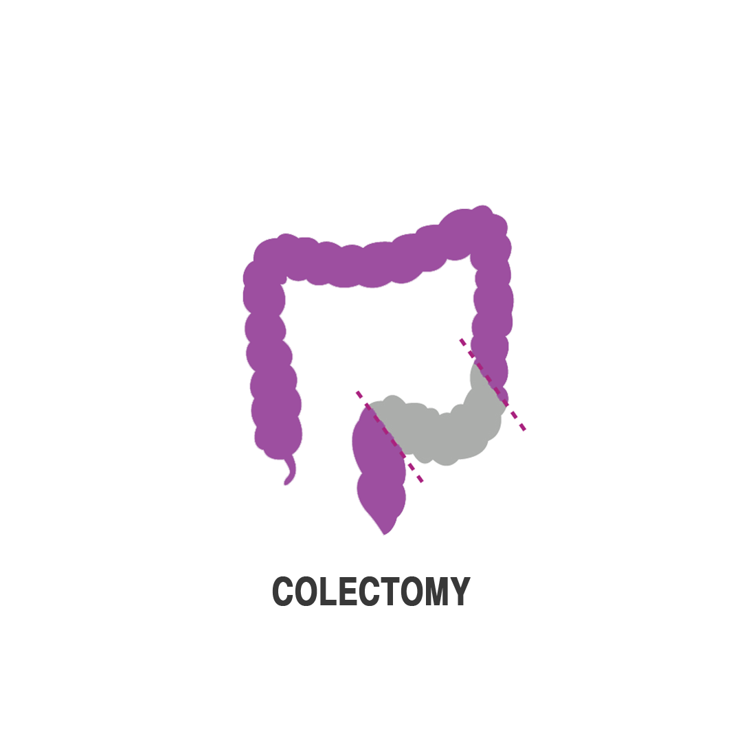 استئصال القولون بالمنظار