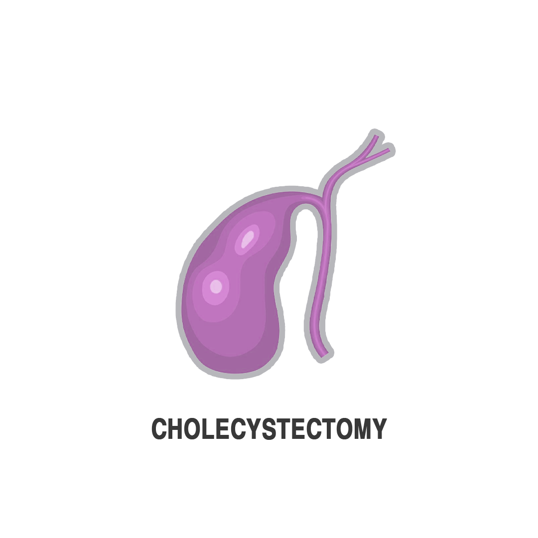 استئصال المرارة بالمنظار