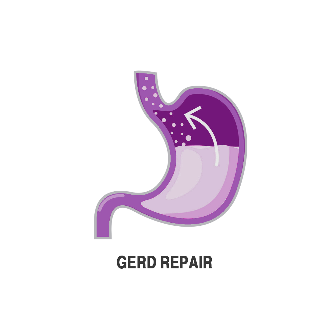 اصلاح ارتجاع المرئ