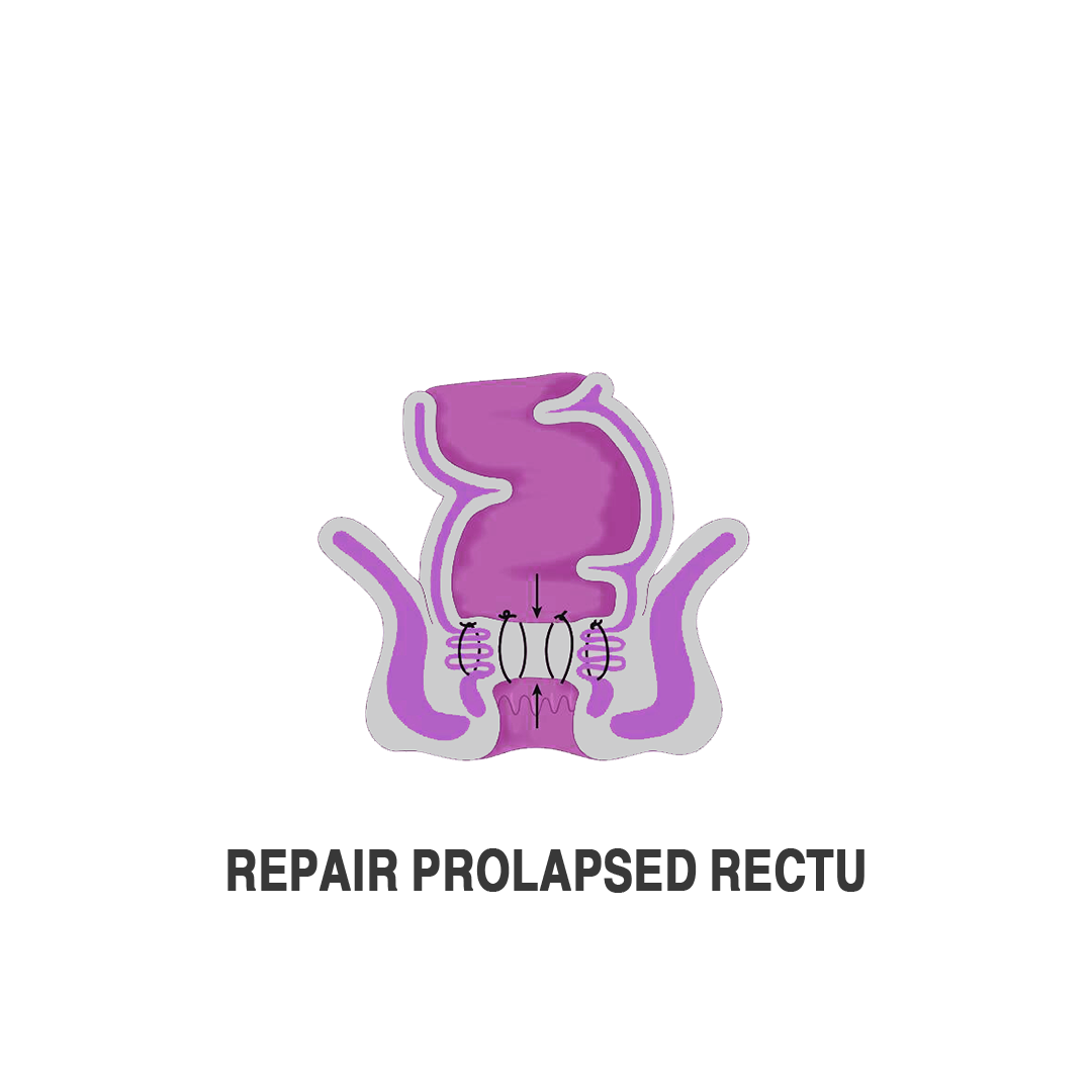 اصلاح السقوط الشرجي