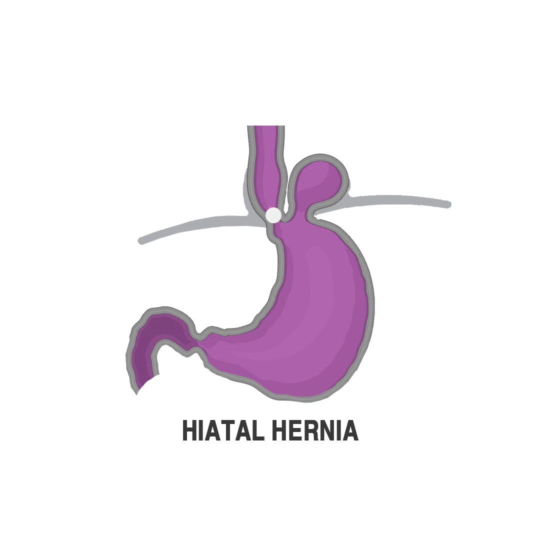 اصلاح فتق الحجاب الحاجز