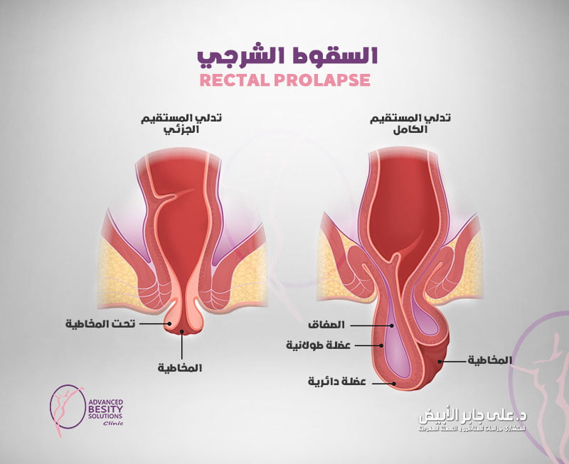 السقوط الشرجي