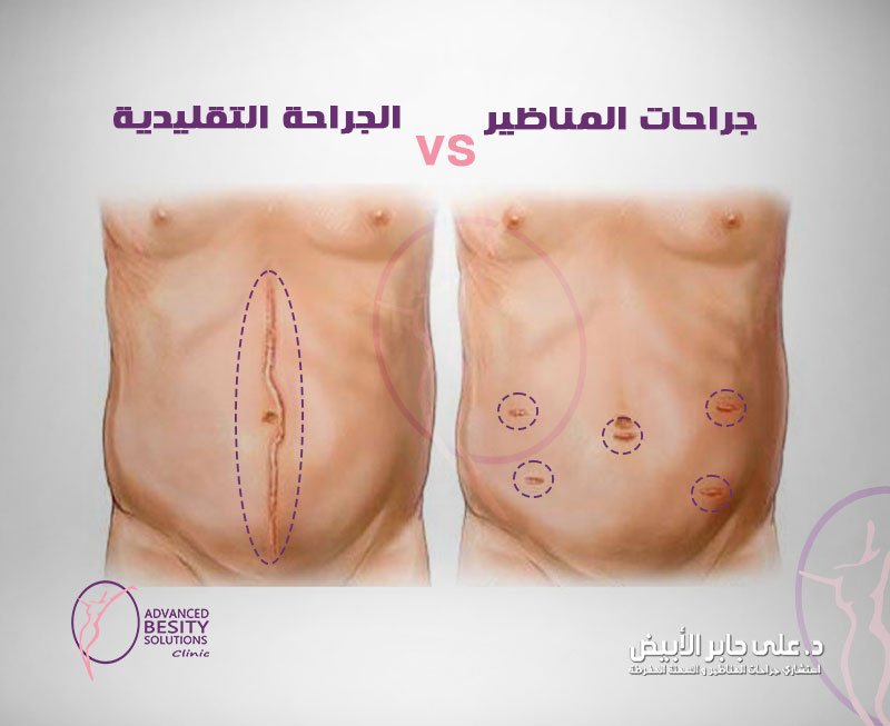 الفرق بين جراحات المناظير والجراحة التقليدية