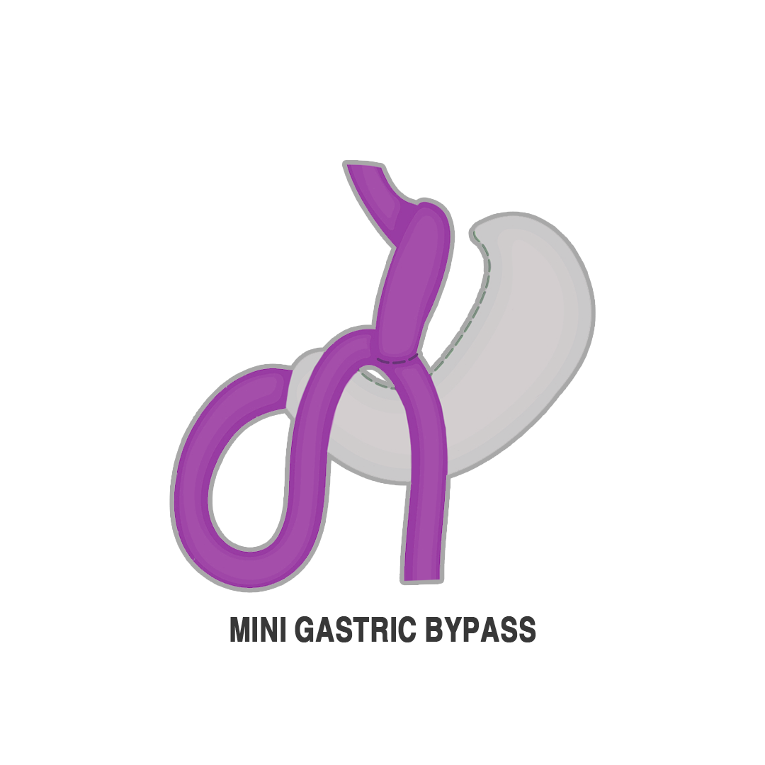 تحويل المسار المصغر