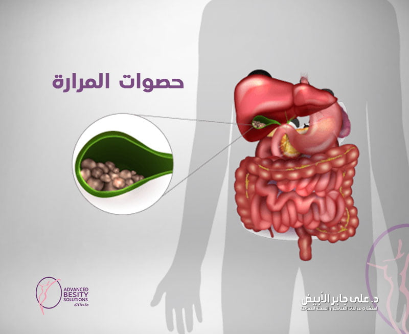 حصوات المرارة