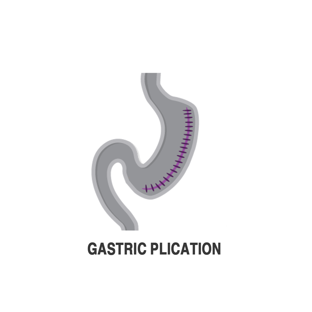 طي المعدة الدقيق