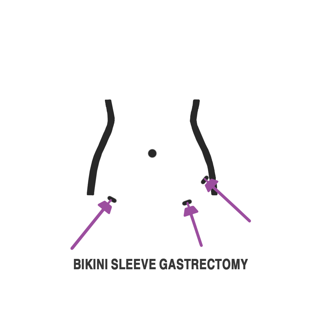 عملية التكميم البكيني