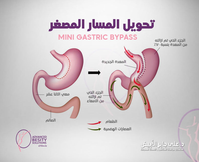 تحويل المسار المصغر واحدة من أنواع عمليات السمنة