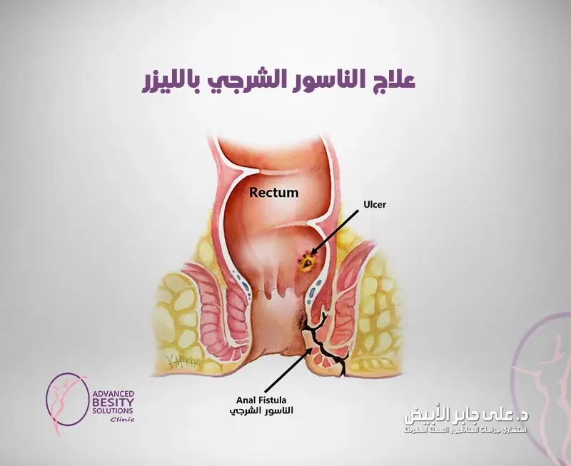 علاج الناسور الشرجي بالليزر أحد جراحات الشرج بالليزر