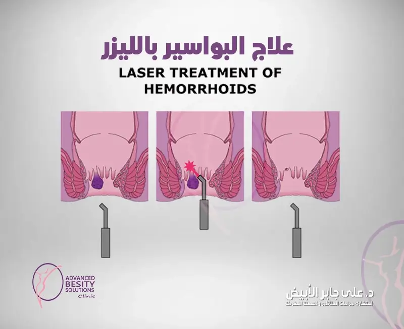 عملية البواسير بالليزر أحد جراحات الشرج بالليزر